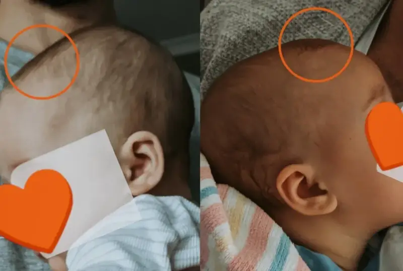 Dwa ujęcia główki niemowlaka, na których widoczny szew czołowy.
